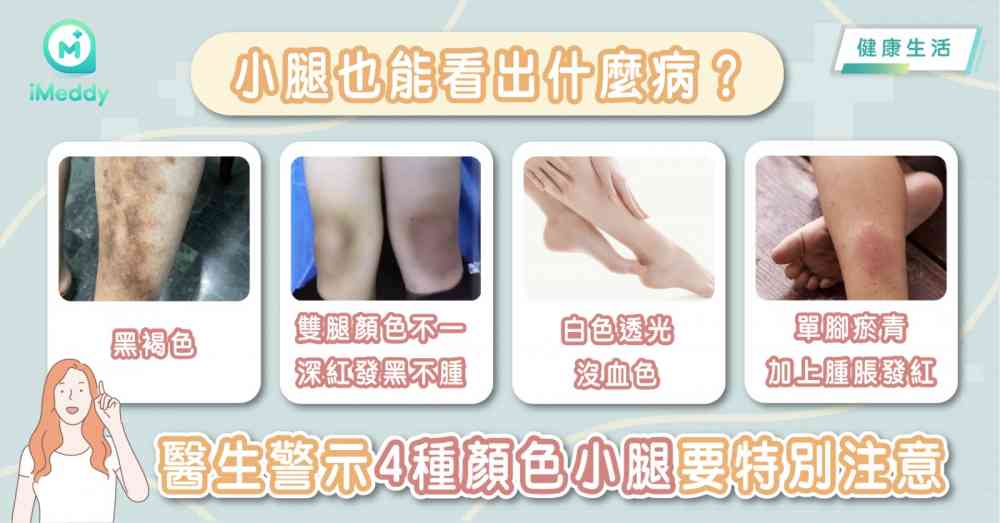 小腿也能看出什麼病 醫生警示4種顏色小腿要特別注意